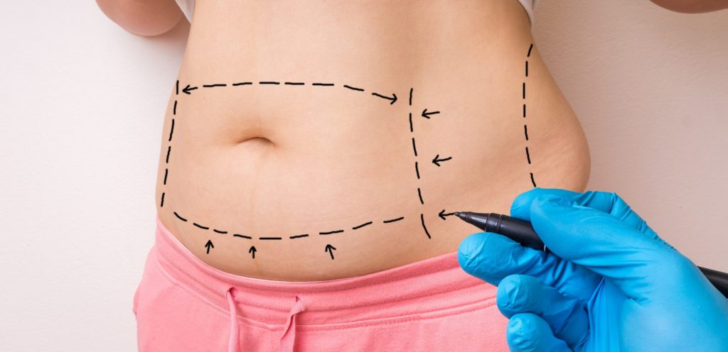 Abdominoplastia