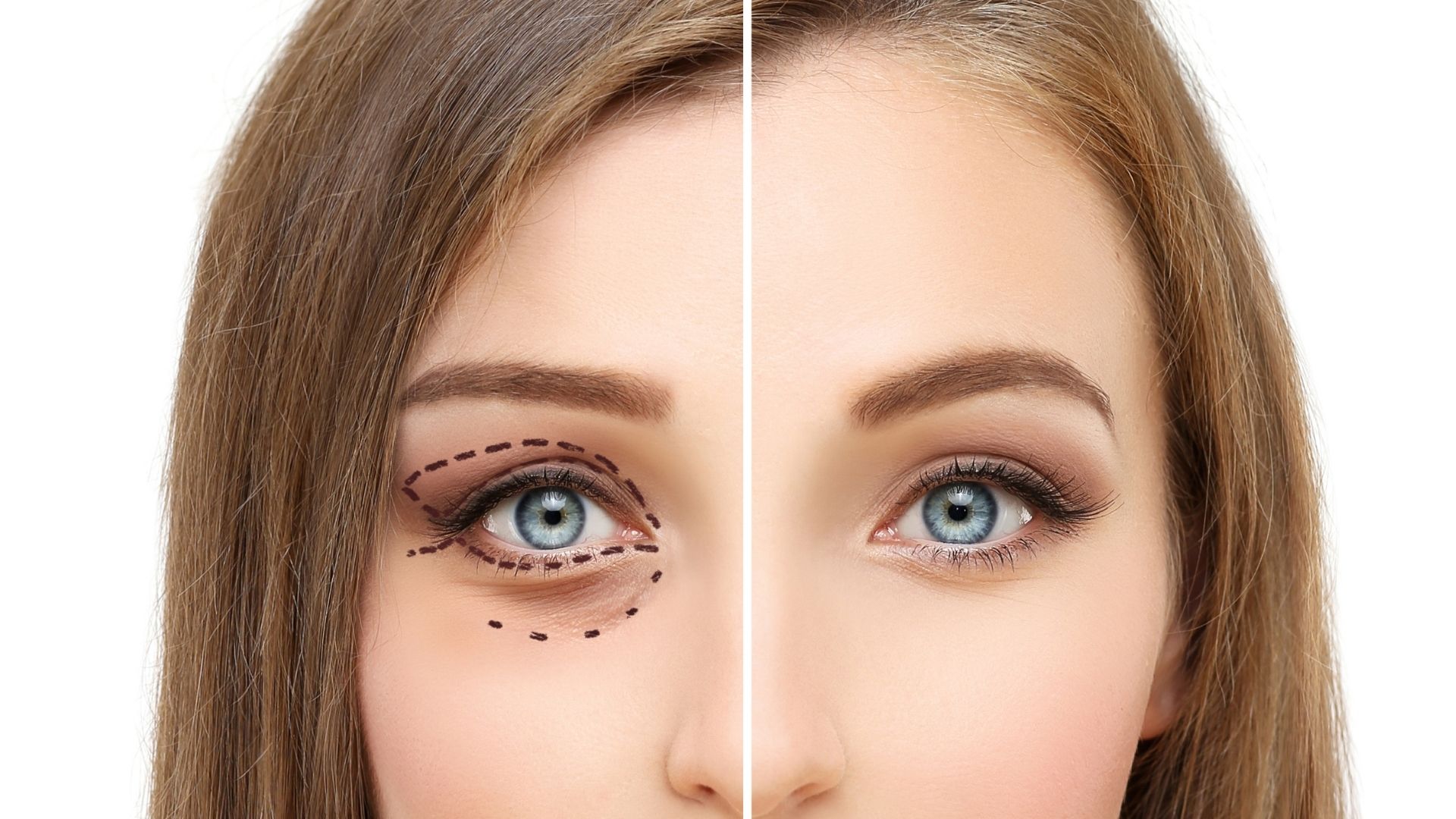 Blefaroplastia