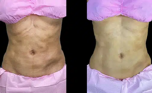 Fibrosis