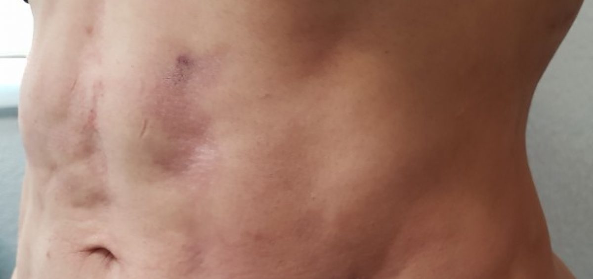 Post Operatoria Tardía
