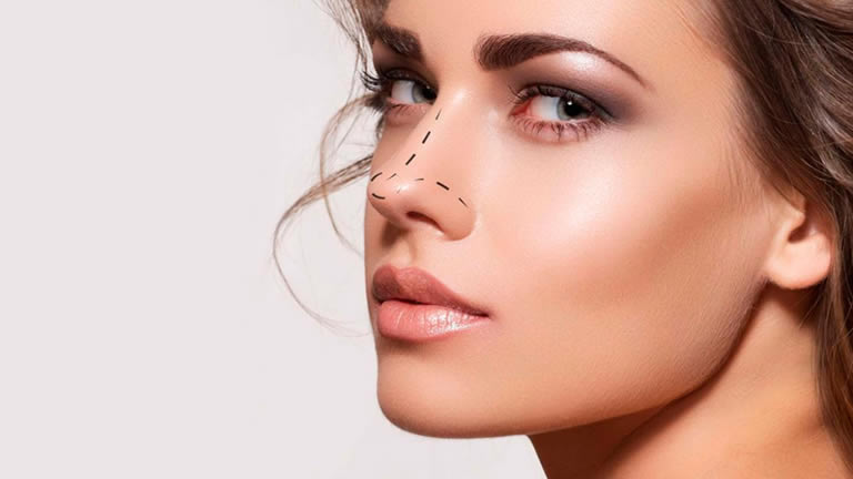 Rinoplastia