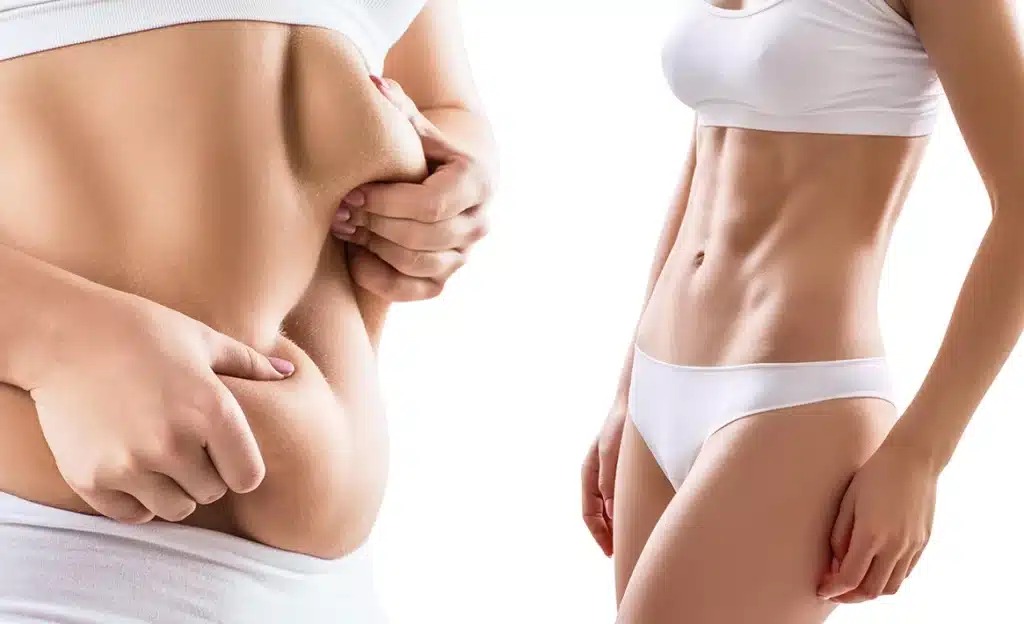 Lipo J-Plasma